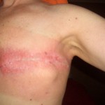 12-days-post-radiation-150x150