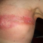 9-days-Post-radiation--150x150