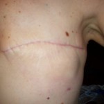 Radiation-day-1-150x150